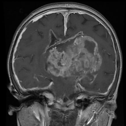 Evaluation of Supratentorial High-Grade Gliomas in Children - The ISPN ...