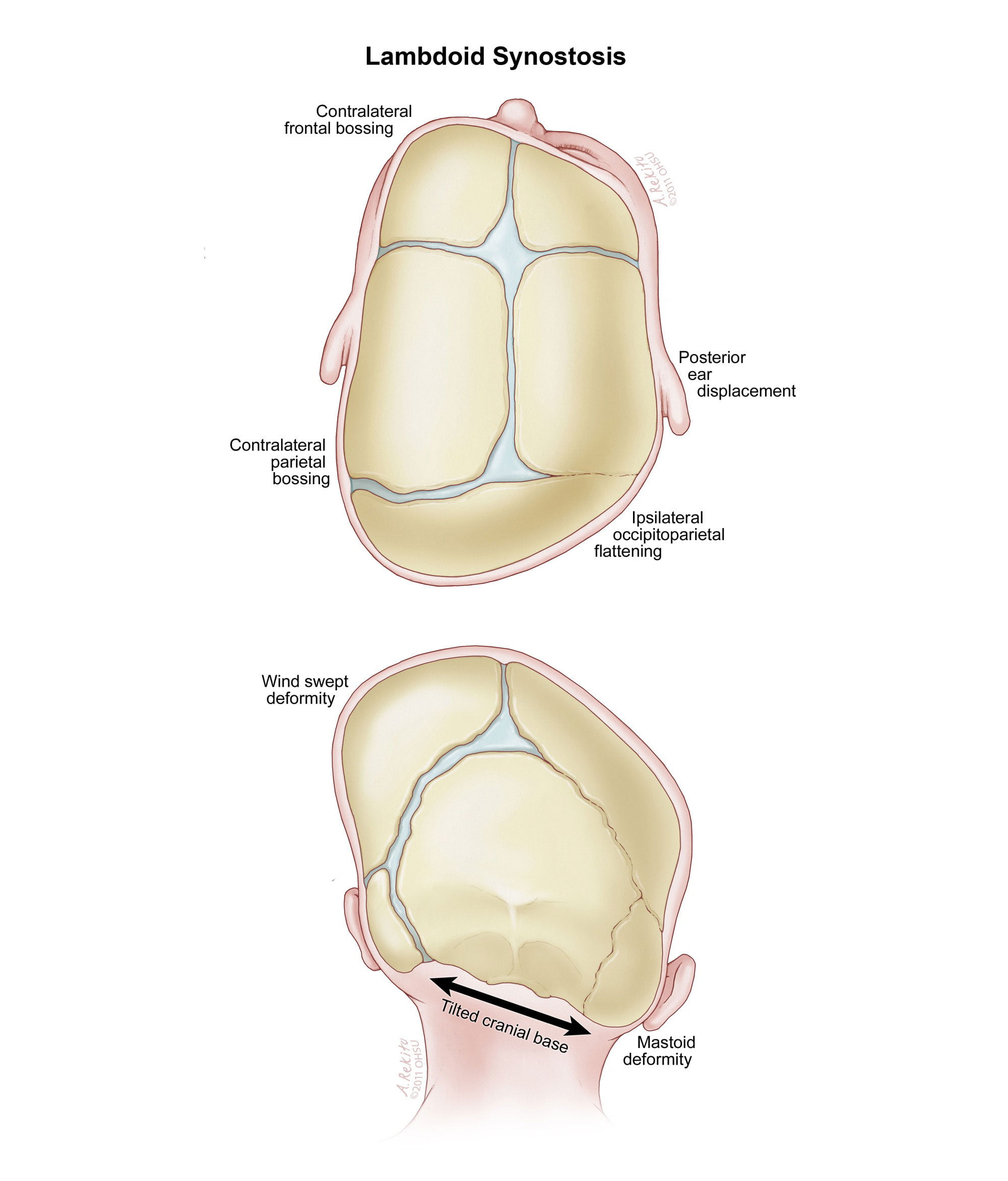 anterior plagiocephaly