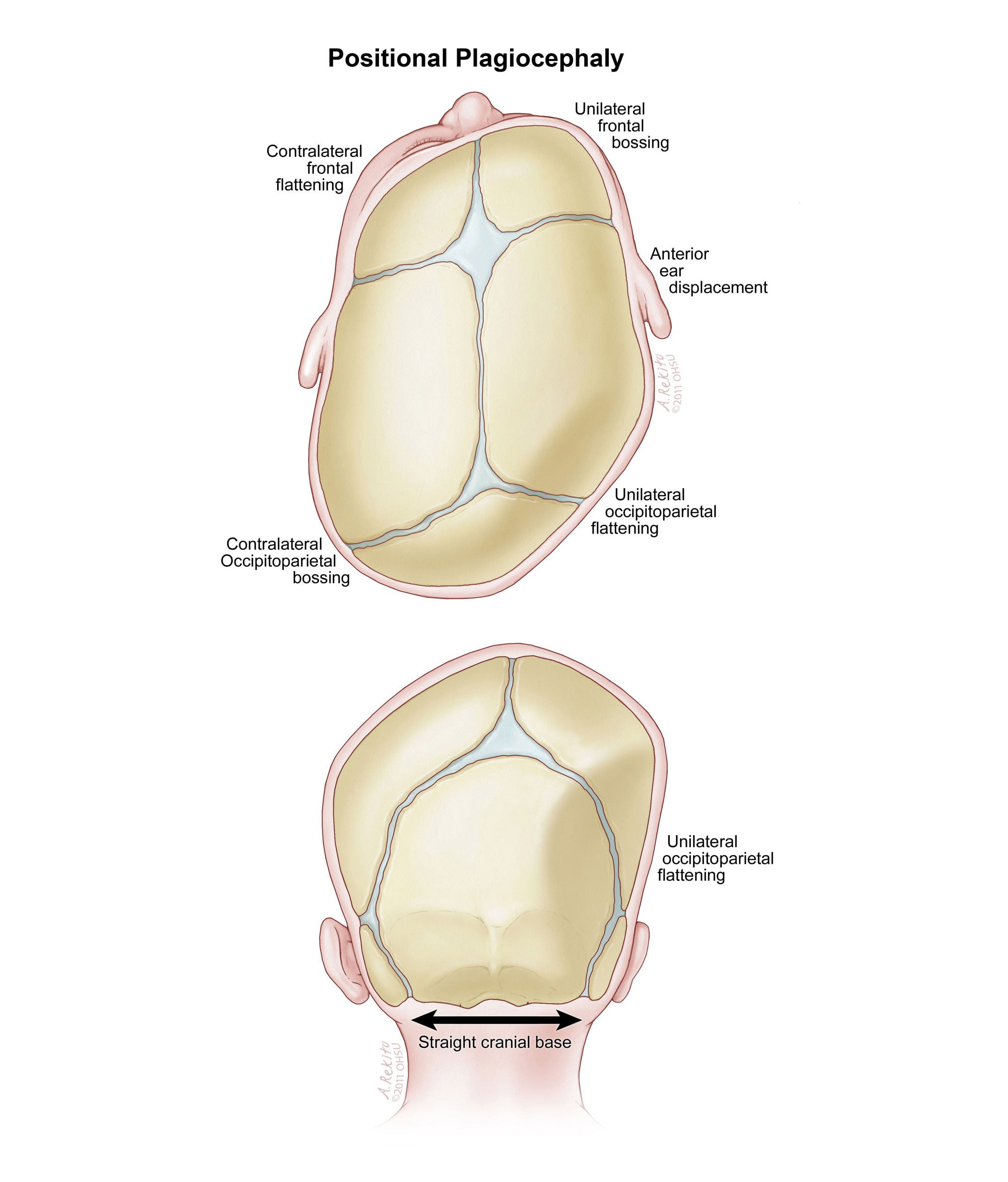 posterior plagiocephaly