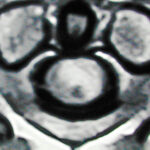 Gadolinium Enhanced T1 Weighted Axial MRI of a Spinal Cord Tumor: