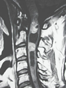 Gadolinium Enhanced T1 Weighted Sagittal MRI of a Spinal Cord Tumor