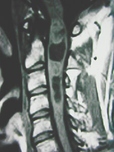 Spinal Cord Astrocytoma T1 Weighted Sagittal MRI