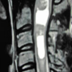 T2 Weighted Sagittal MRI of a Spinal Cord Astrocytoma