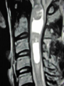 T2 Weighted Sagittal MRI of a Spinal Cord Astrocytoma