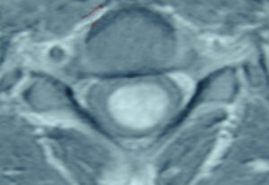T1 weighted Axial MRI of a C3-T1 intramedullary astrocytoma: Sagittal MRI of a C3-T1 intramedullary astrocytoma