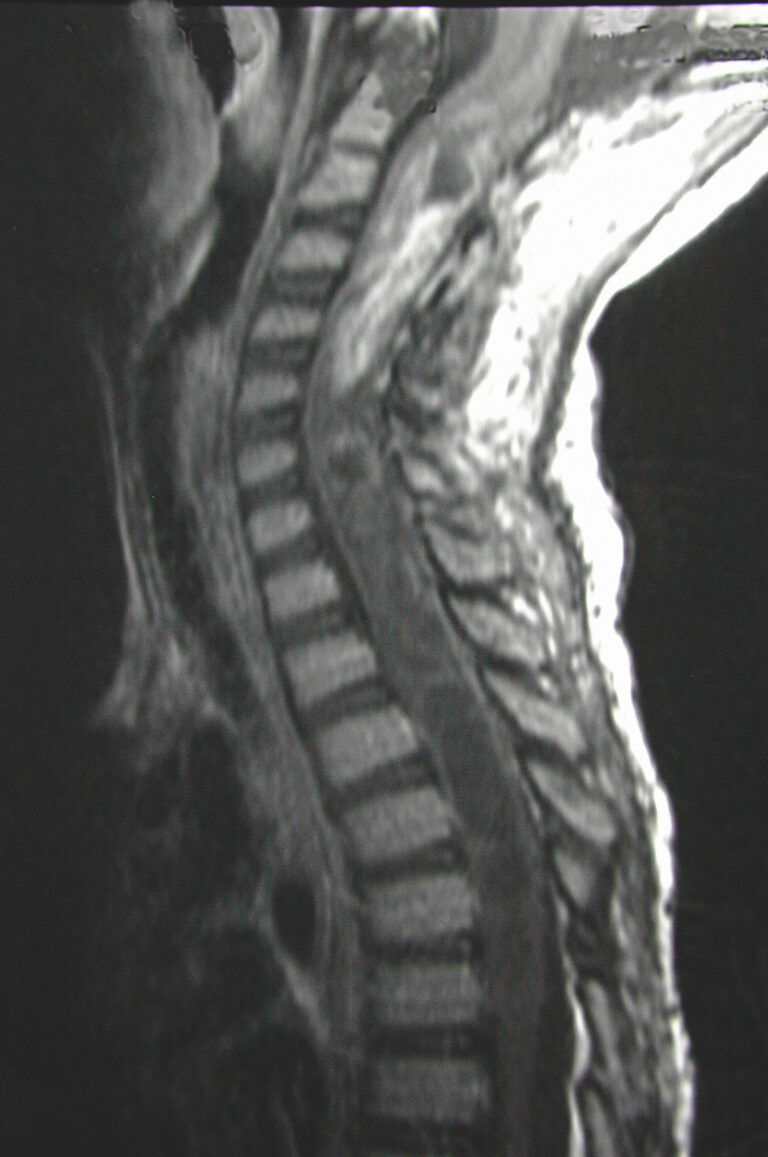 Gadolinium Enhanced Sagittal T Weighted Mri Of A Cervico Thoracic Intramedullary Spinal Cord