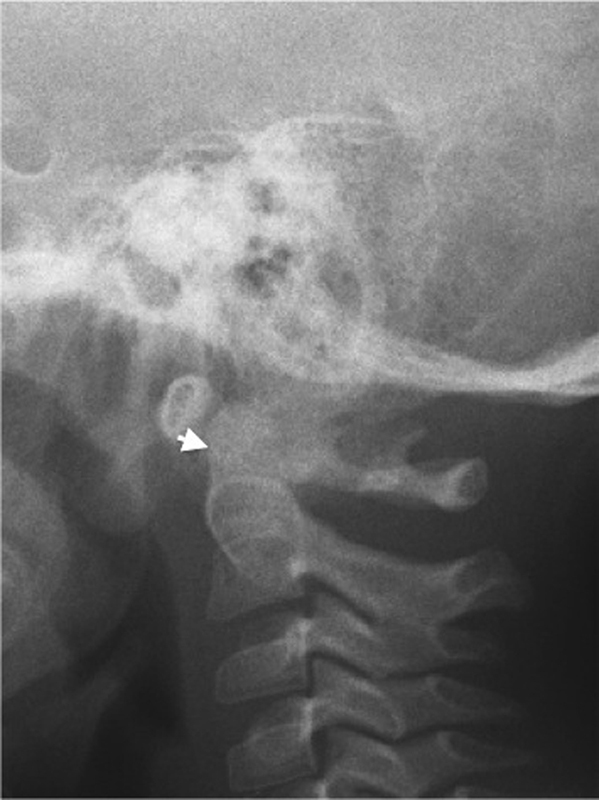 X-Ray of C-Spine in neutral position, lateral view.