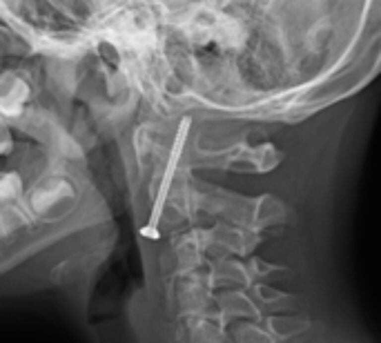 partial odontoid fracture