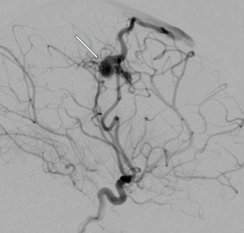 DSA of AVM, lateral view: Image shows an AVM (white arrow) fed from the MCA.