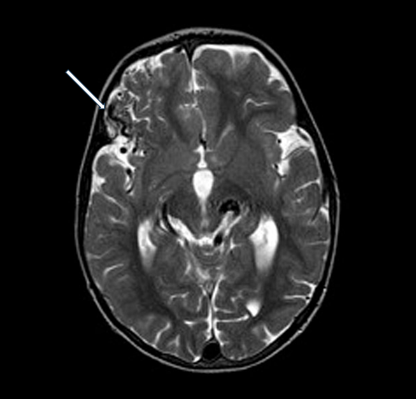 T2-weighted axial MRI of AVM A (white arrow)