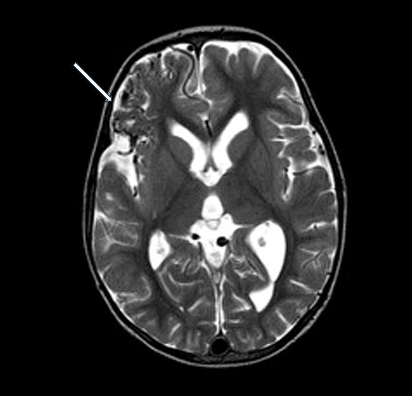 T2-weighted axial MRI of AVM B (white arrow)
