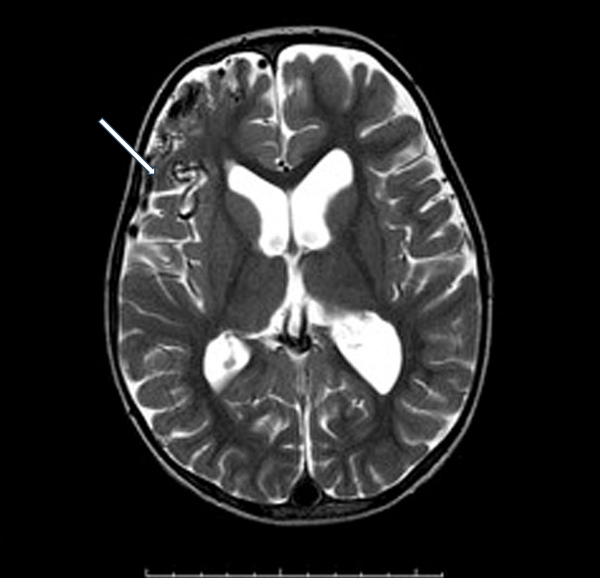 T2-weighted axial MRI of AVM C (white arrow)