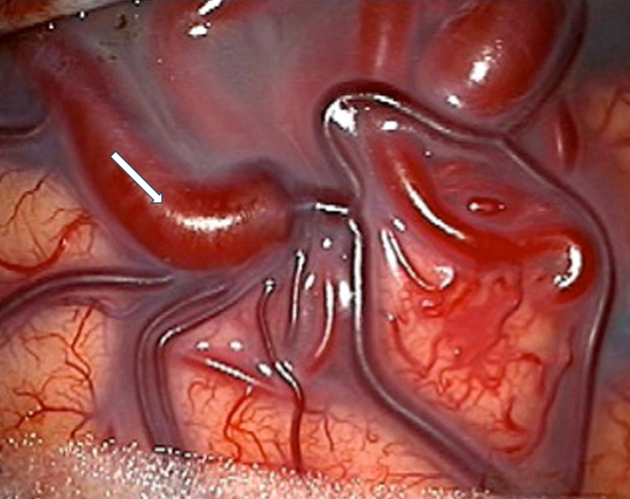 Intraoperative image of cortical AVM: Note the dilated and arterialized draining vein (white arrow).